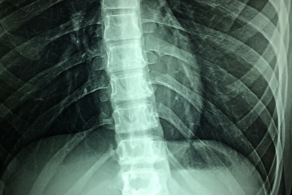What Causes Spinal Cord Injuries in Georgia?