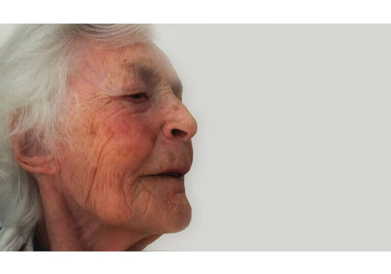 Facial-Injuries-Are-Prevalent-in-Long-Term-Care-Facilities